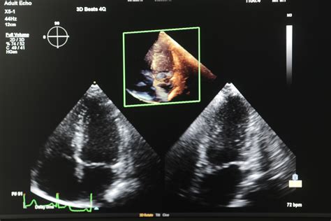 2D/3D ECHOCARDIOGRAPHY .